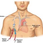 CVCatheter