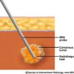 RFA_kills_tumors_with_heat