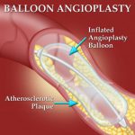 angioplasty