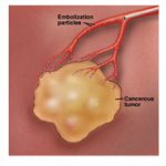 chemoembolization