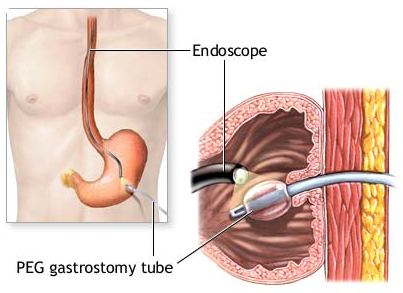 gastrostomy