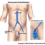 varicocele_embolization